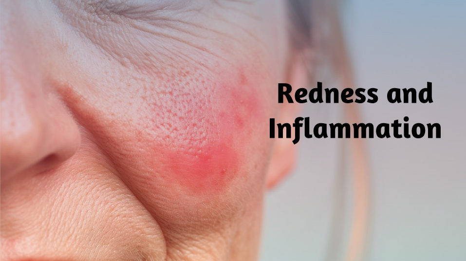 Close-up of facial redness commonly experienced after a chemical peel.