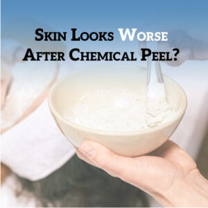 Skin Looks Worse After Chemical Peel?- Before and after results of a chemical peel treatment showing improved skin texture and tone.